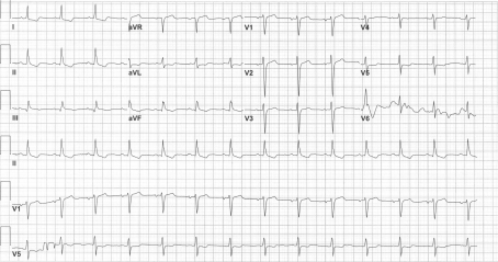ECG lateral changes